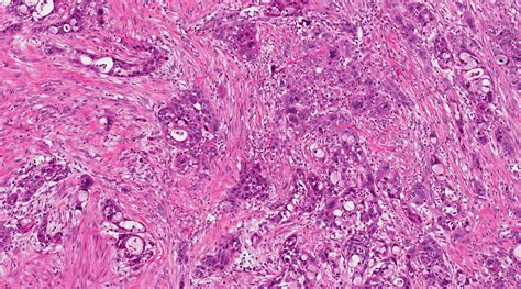 Pathology Outlines - Molecular genetics of pancreatic cancer