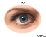 Treatment and Symptoms of a Stye on the Eyelid | Eye stye remedies, Skin care remedies, Skin care