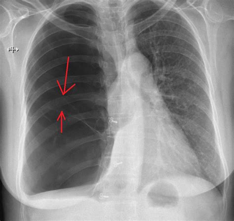 Emphysema Chest X Ray