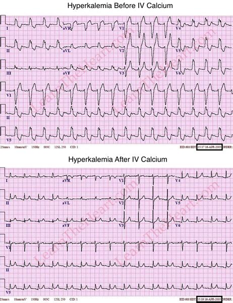 Hyperkalemia ECG Review | Learn the Heart