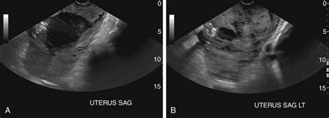 Bleeding with Pregnancy | Radiology Key