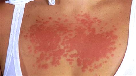 Poison ivy, sun poisoning, heat rash: A guide to summer rashes - TODAY.com