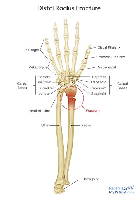 Distal Radius Fracture: Signs, Symptoms, Causes, And Treatment Options ...