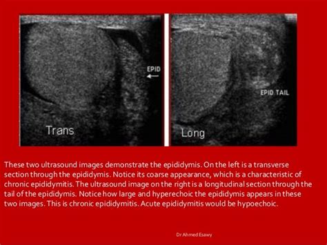 Imaging orchitis epidydmitis epidydmo orchitis DrAhmed Esawy