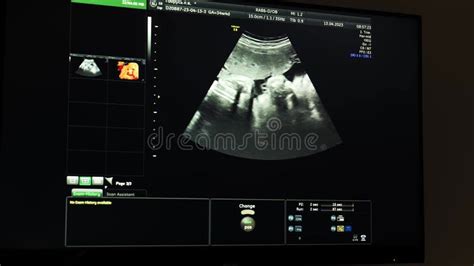 Ultrasound of a Baby in the Womb Close-up Stock Footage - Video of motherhood, closeup: 298672010