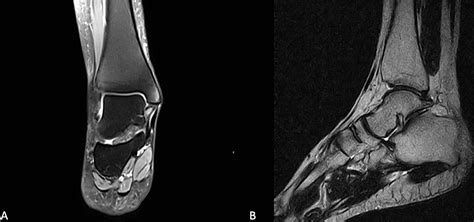 Cureus | Approach to Ankle Instability in Patients With a Negative ...