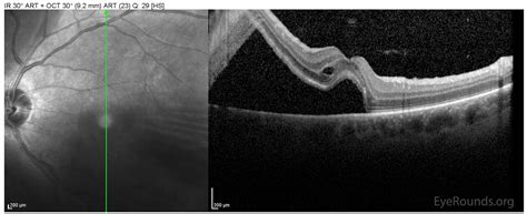 Tractional Retinal Detachment Oct