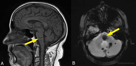 EyeRounds.org:Intralenticular Foreign Body : 23 year-old male with ...