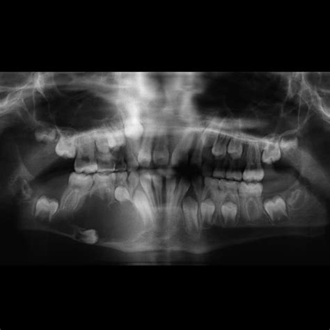 Odontogenic keratocyst | Radiology Case | Radiopaedia.org | Radiology ...