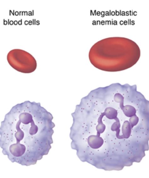 A common B12 deficiency is megaloblastic anemia. This is a condition where the bone marrow ...