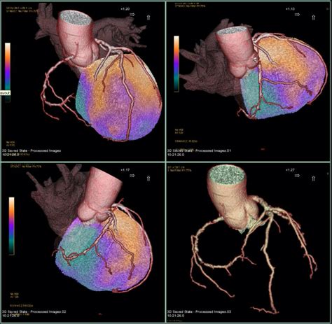 Cardiovascular Research | Institute of Nuclear Medicine - UCL ...