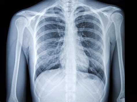 Normal Lung Ct Scan