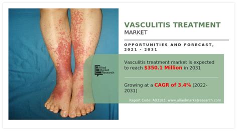 Vasculitis Treatment Market Aims for a $350.1 Million Horizon