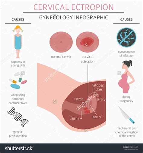 Cervical Ectropion Ginecological Medical Desease Infographic Stock ...