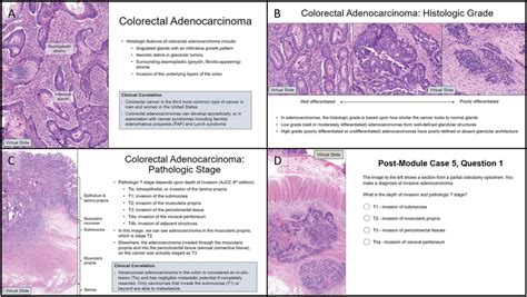 Colon Pathology Module, covering colorectal adenocarcinoma. Sequential... | Download Scientific ...