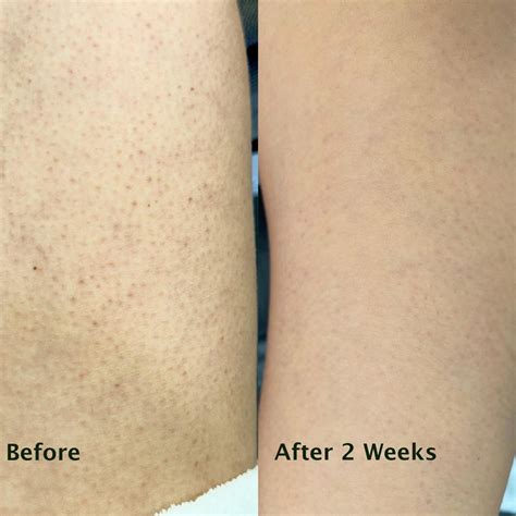 Keratosis Pilaris Treatment: How I Got Rid Of My Keratosis Pilaris (Chicken Skin)