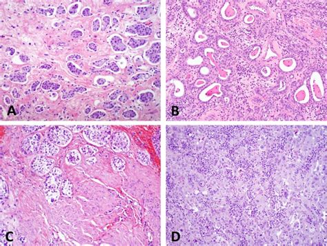 What Is the Significance of Variant Histology in Urothelial Carcinoma? - European Urology Focus