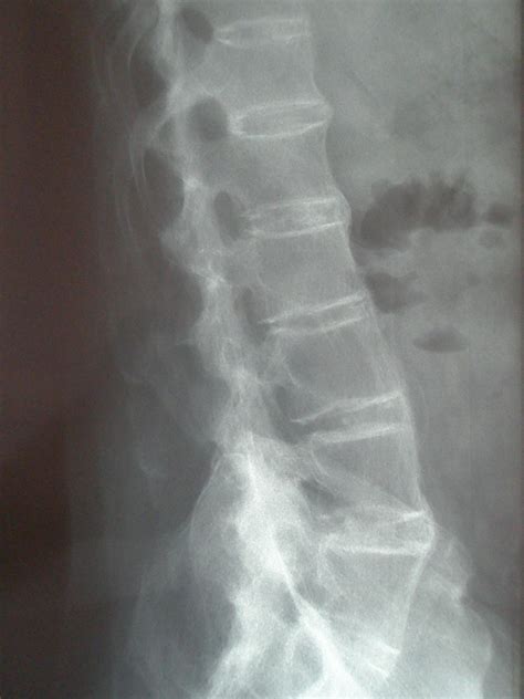 Ankylosing Spondylitis, Bamboo spine - DocCheck