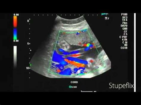 Ultrasound video of hypocoiled umbilical cord - YouTube