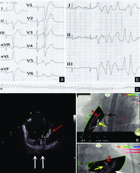 The electrocardiograph and the anatomy of moderator band of the... | Download Scientific Diagram