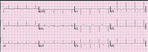 Dr. Smith's ECG Blog: Dynamic T-wave inversion (apparent Wellens' waves ...