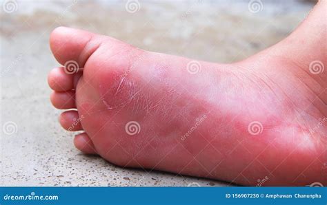 Asian Child Girl `s Right Foot with Red Rash and Swelling from a Bee ...