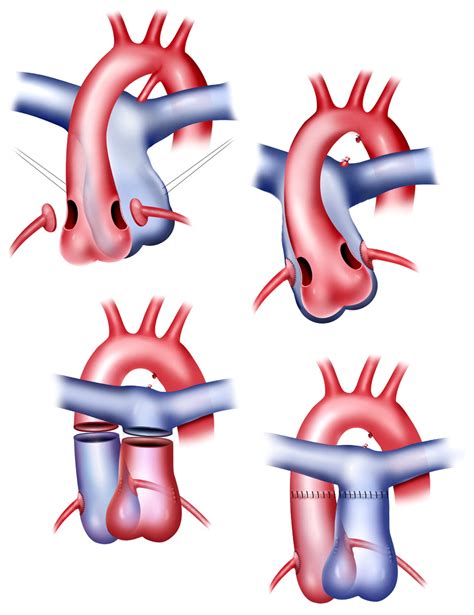 Jatene Procedure - RNpedia