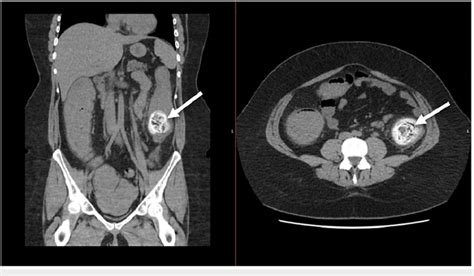 The patient's CT scan (case one) A coronal (left) and transverse... | Download Scientific Diagram