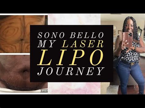 MY SMART LIPO JOURNEY With SONO BELLO BEFORE & AFTER PICS!! || TUMMY TUCK & TRISCULPT COST - YouTube