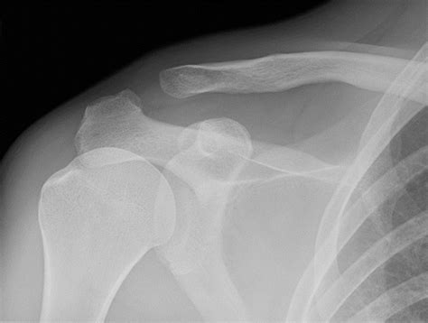 Acromioclavicular Joint X Ray