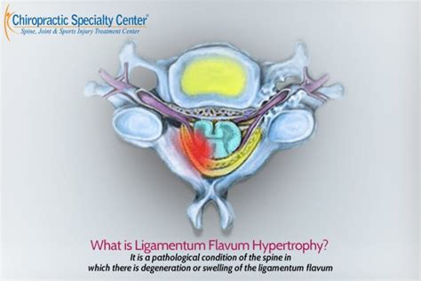 Ligamentum Flavum Hypertrophy | Definition, Cause & Treatment