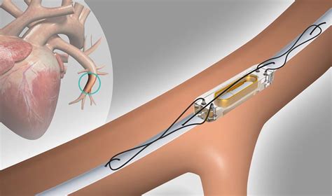 CardioMEMS™ Implant - Center for Advanced Cardiac and Vascular ...