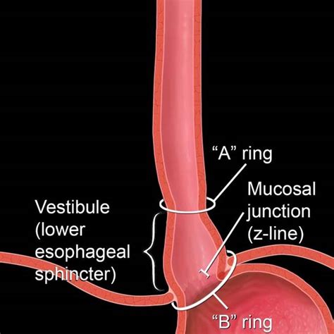 Esophagus Hernia