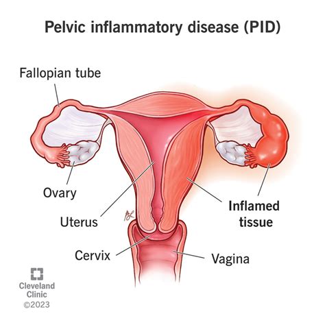 Pelvic Inflammatory Disease Antibiotics