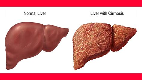 Nursing Interventions for Liver CirrhosisNursing File | Nursing File