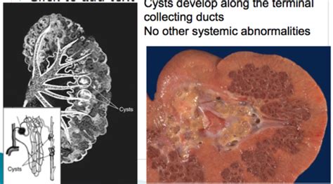 Congenital + Cystic Kidney Diseases - part 2 Flashcards | Quizlet
