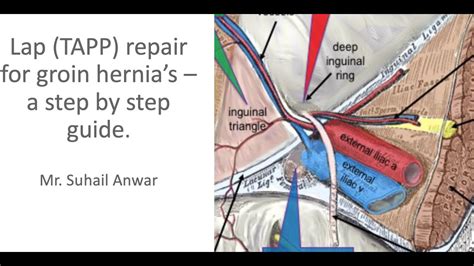 Laparoscopic Hernia Repair Taap For Right Side Complete Inguinal Hernia ...