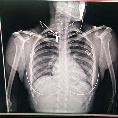 Normal Chest X Ray Images