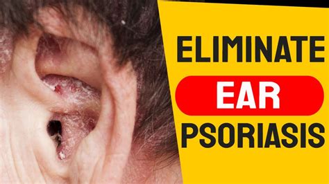 Winter Ear Care for Psoriasis | How to Treat Psoriasis of the Ears - YouTube