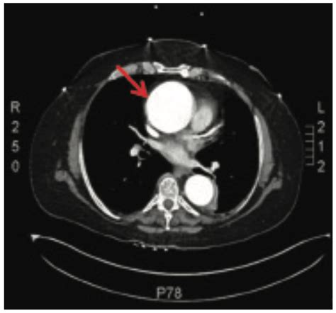 Management of an Ascending Aortic Aneurysm Diagnosed in an Outpatient ...