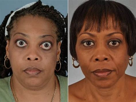 Thyroid Eye Disease Before and After | W Cosmetic Surgery