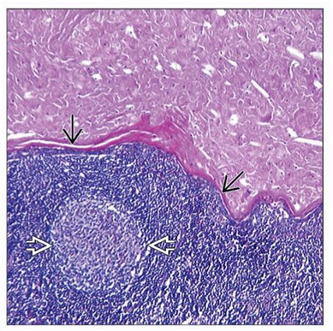 Branchial Cleft Cyst Histology