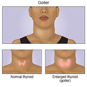 Goiter Hypothyroidism