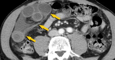 The Radiology Assistant : Closed Loop Obstruction in Small bowel ...