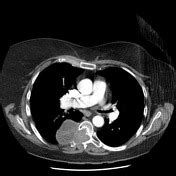 Neurogenic tumors | Radiology Reference Article | Radiopaedia.org