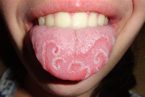 File:Geographic tongue (cropped).jpg - Wikipedia