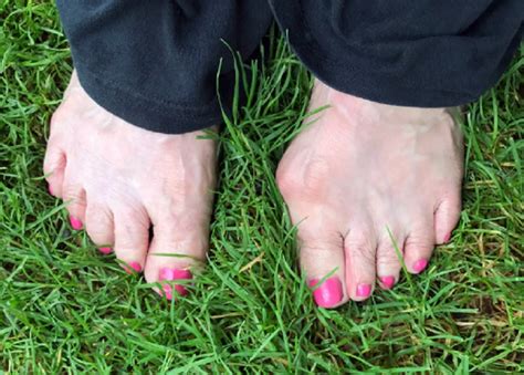 Crooked Toes And How To Correct Them