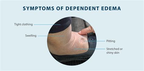 Dependent Edema: Symptoms, Causes, Treatment & More - Tactile Medical