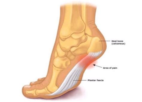 Fascitis Plantar - Clínica Sevila