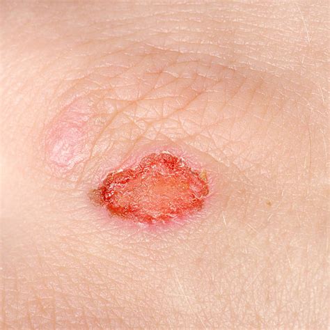 Top 100+ Wallpaper What Does An Infected Wound Look Like? Superb